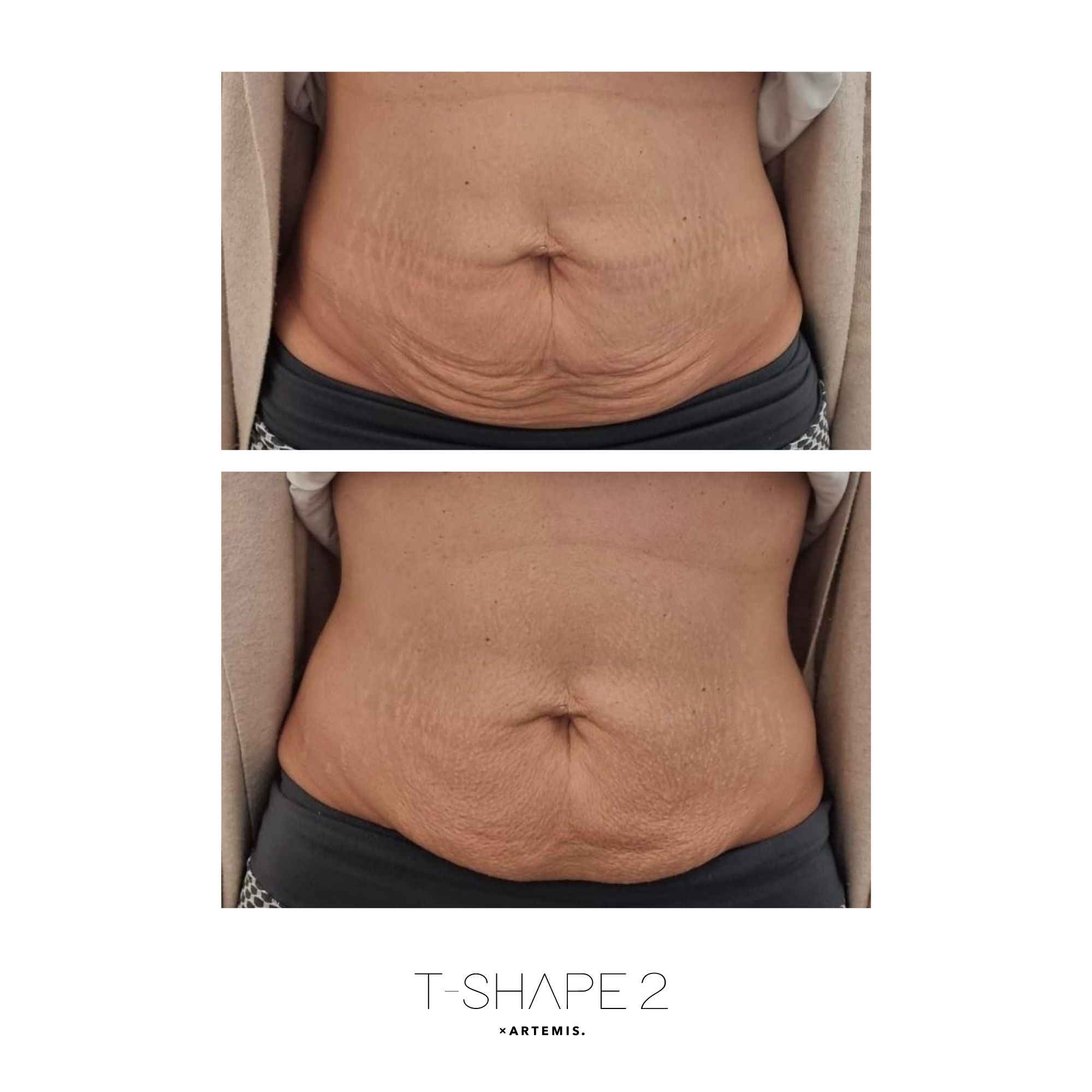 Abdomen T-Shape 2 results — After 3 treatments