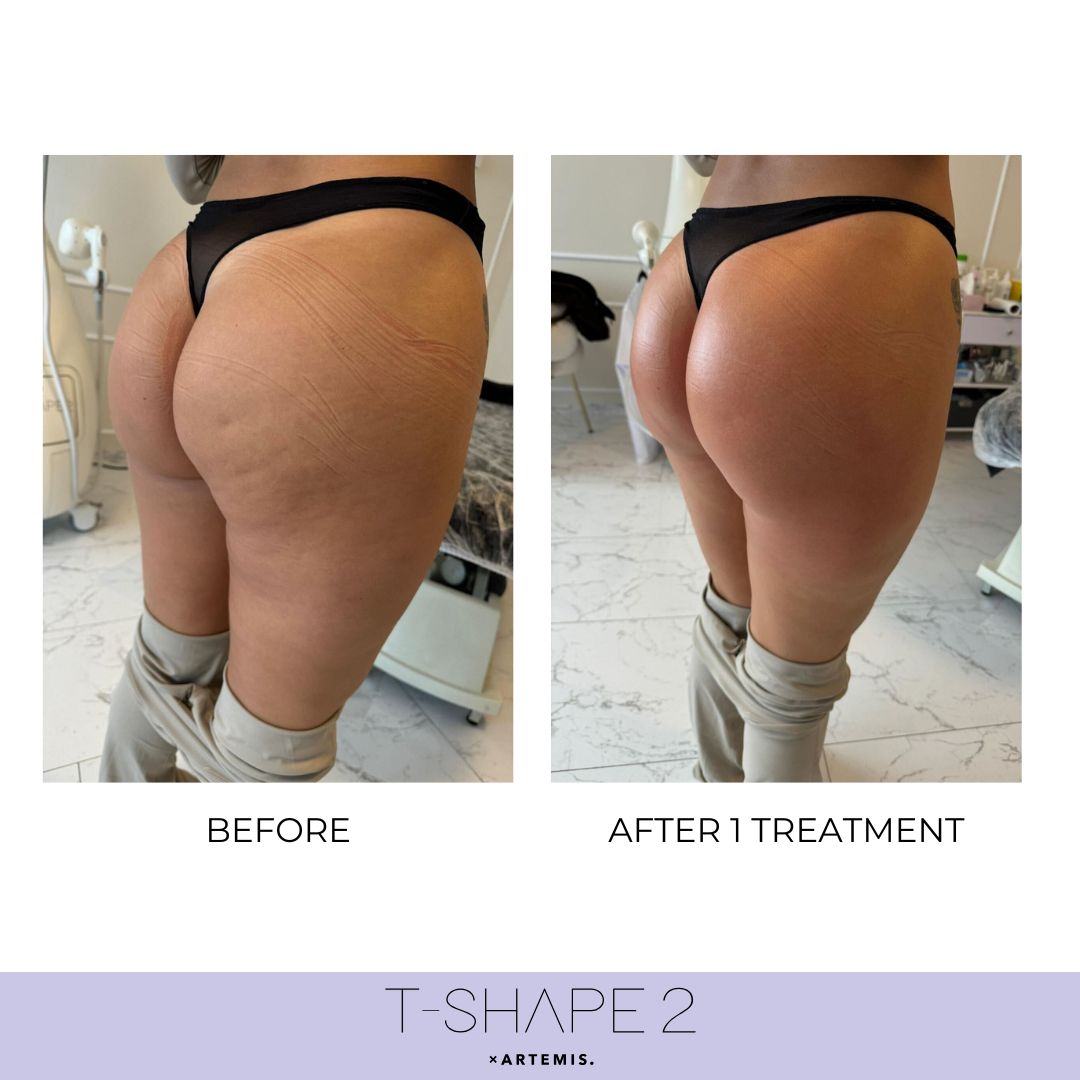 Body T-Shape 2 results — After 1 treatment