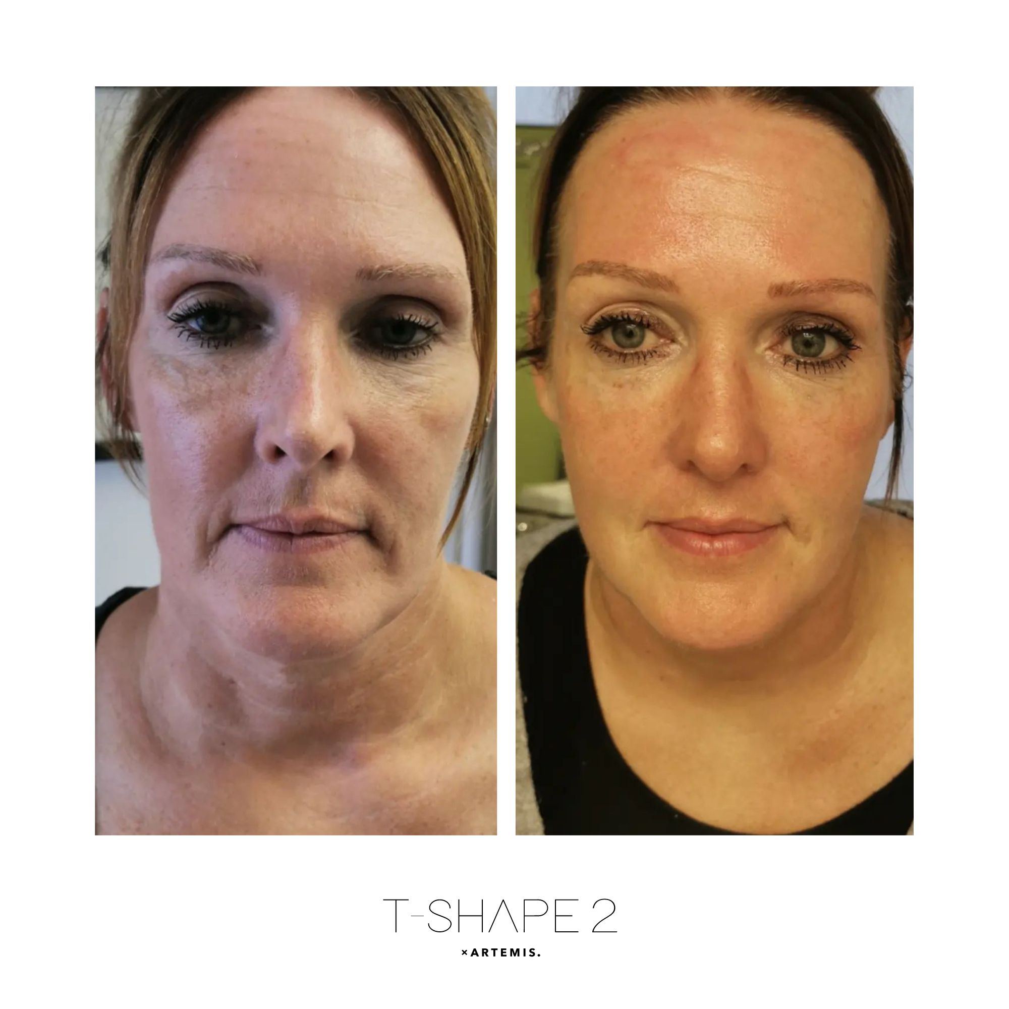 Face & Neck T-Shape 2 results — After 3 treatments