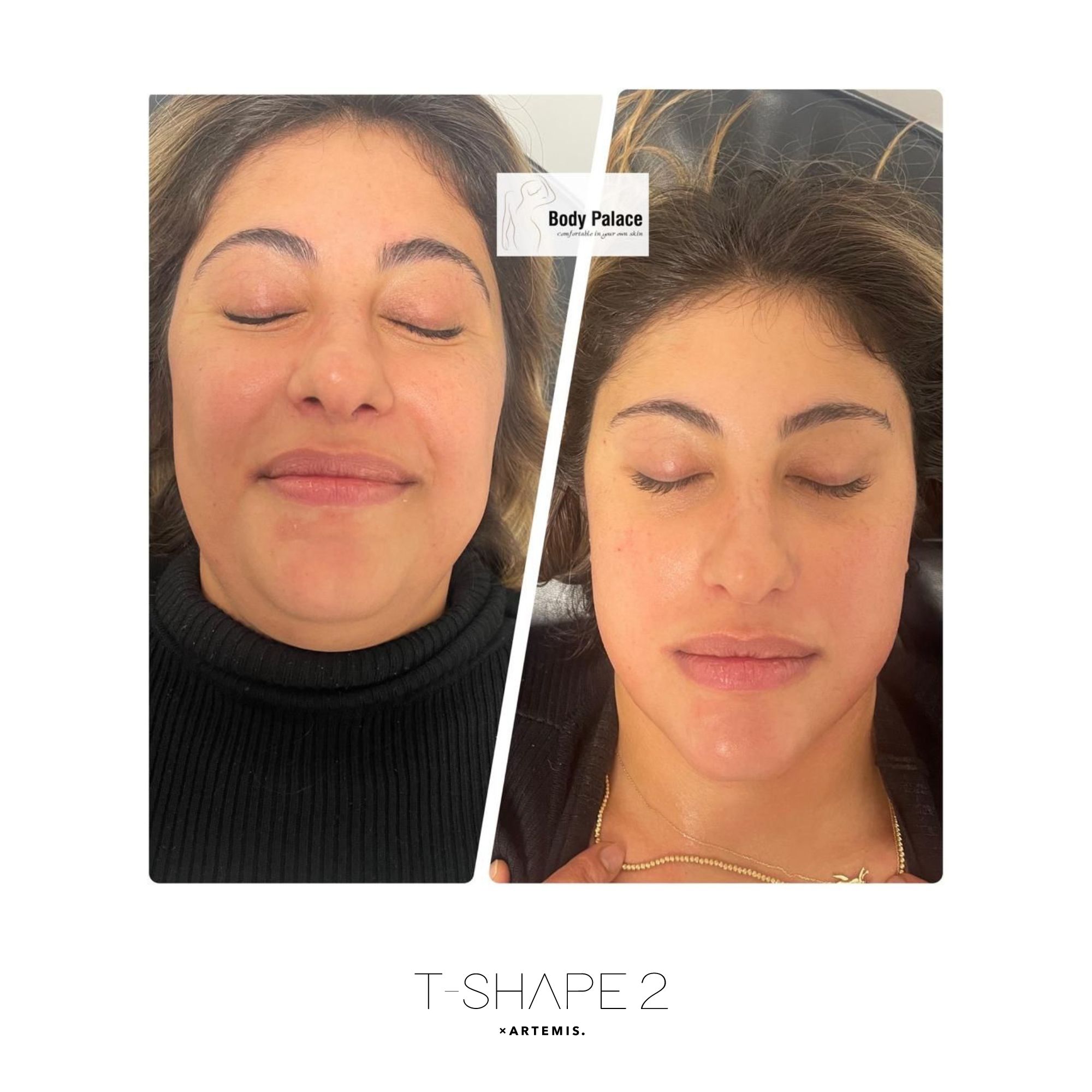 Face T-Shape 2 results — After 4 treatments