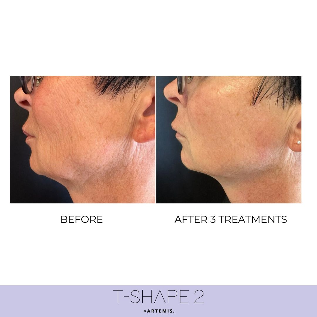 Face T-Shape 2 results — After 1 treatment