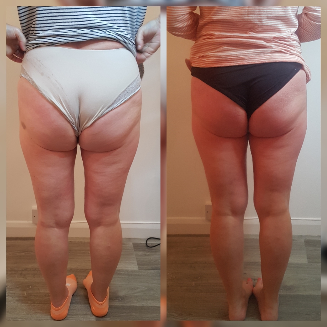 Glutes — T-Shape 2 at iCRYO Daniel Island
